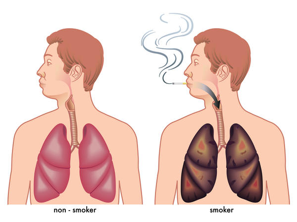 Emphysema